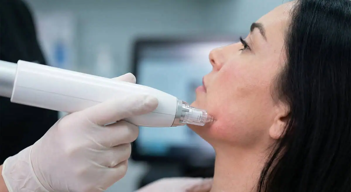 Patient receiving RF microneedling treatment for skin rejuvenation and collagen stimulation in Plainfield, IL.